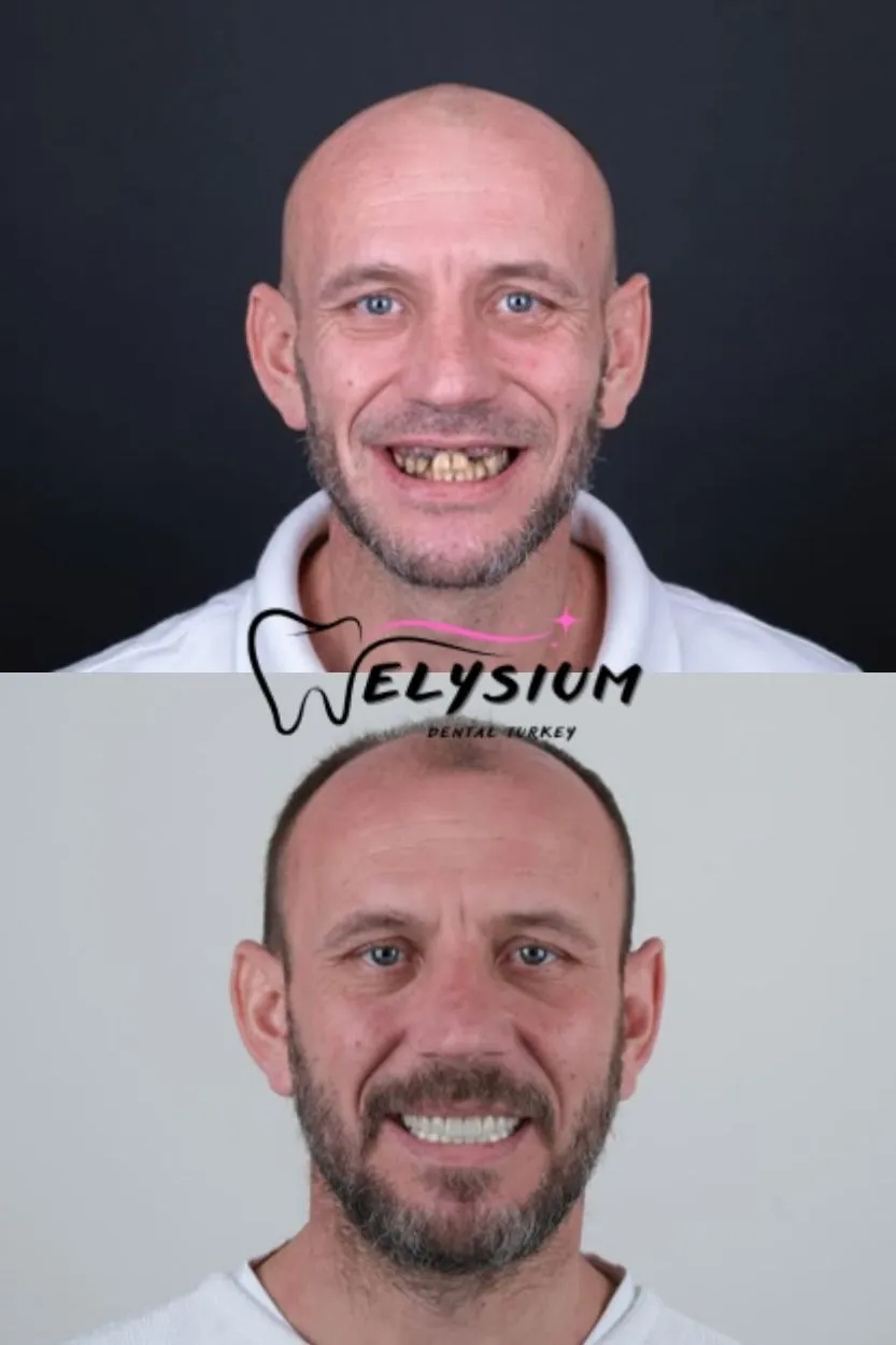 Antalya digital smile design