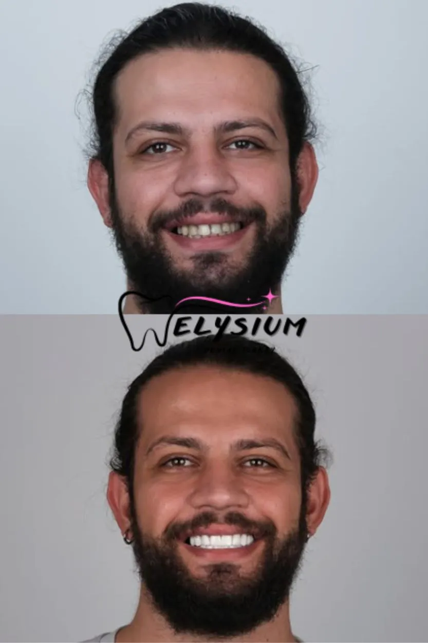 Antalya digital smile design