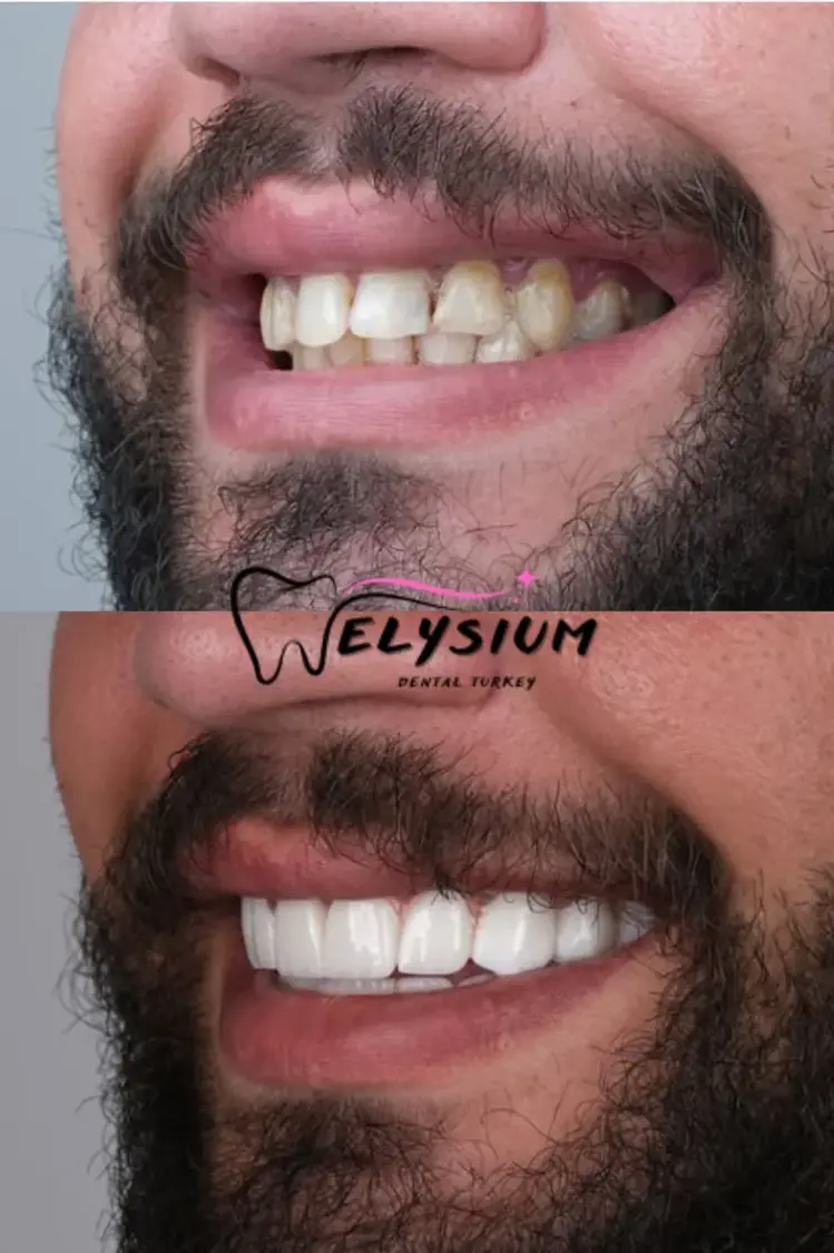 smile design turkey antalya