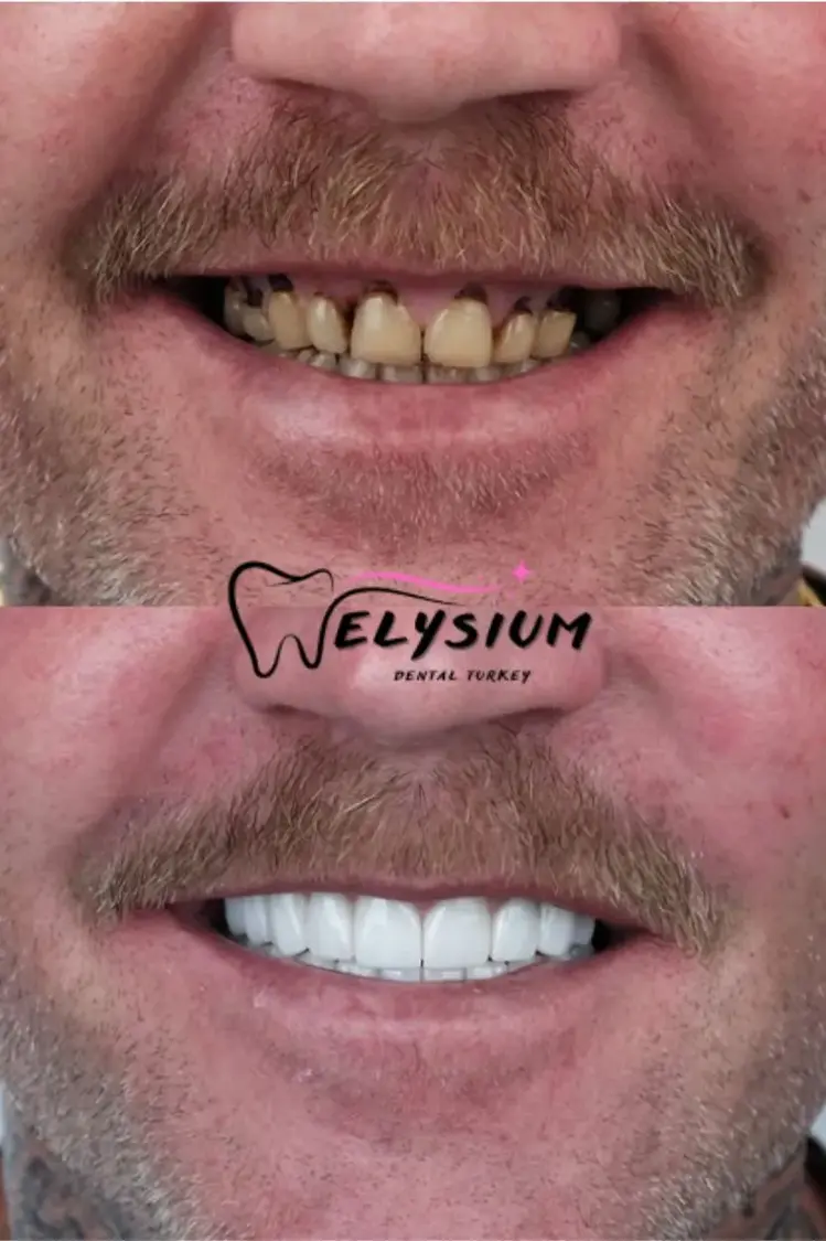 smile design turkey antalya