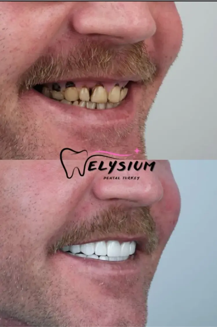 smile design turkey antalya