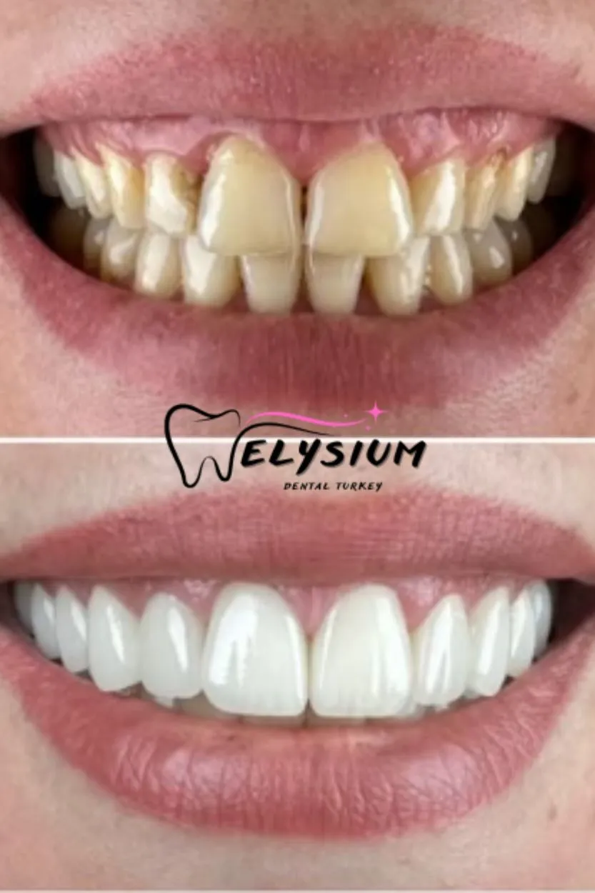 smile design turkey antalya