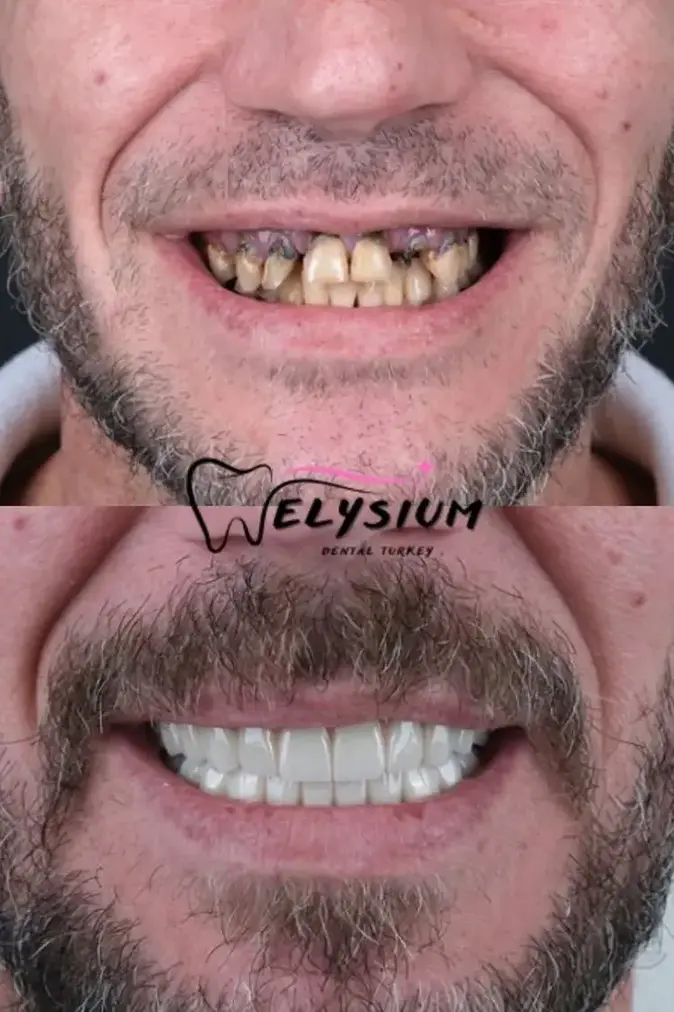 Antalya digital smile design