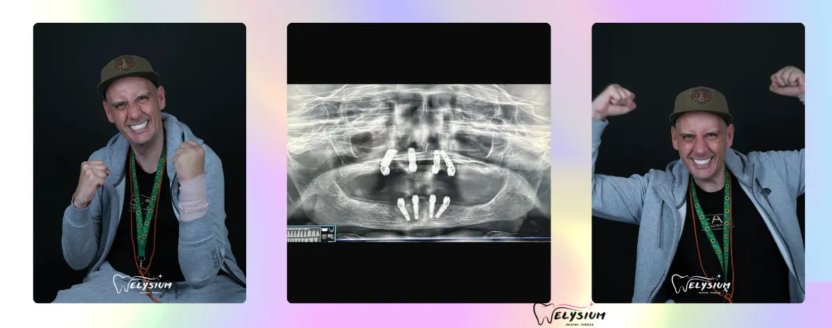 Full mouth dental implant Turkey price Full mouth dental implant Turkey price