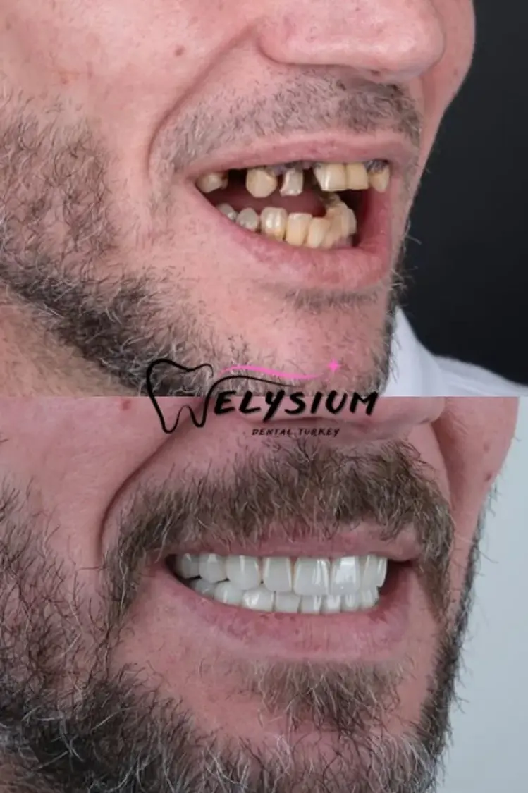 Antalya digital smile design