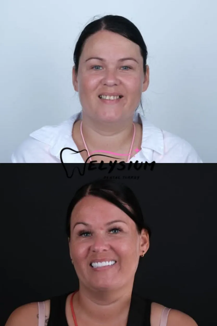 Antalya digital smile design
