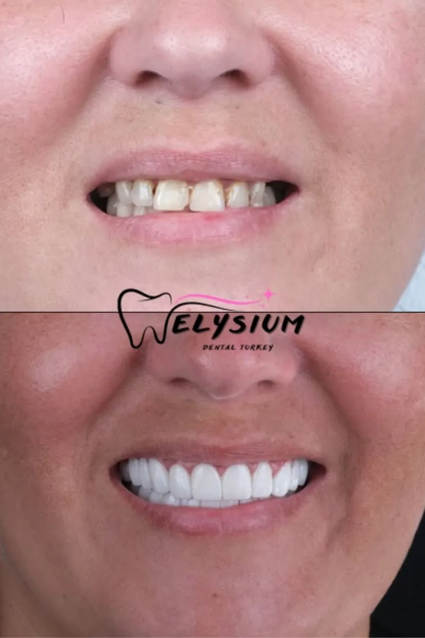 Antalya digital smile design