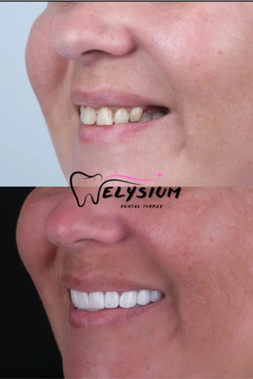Antalya digital smile design