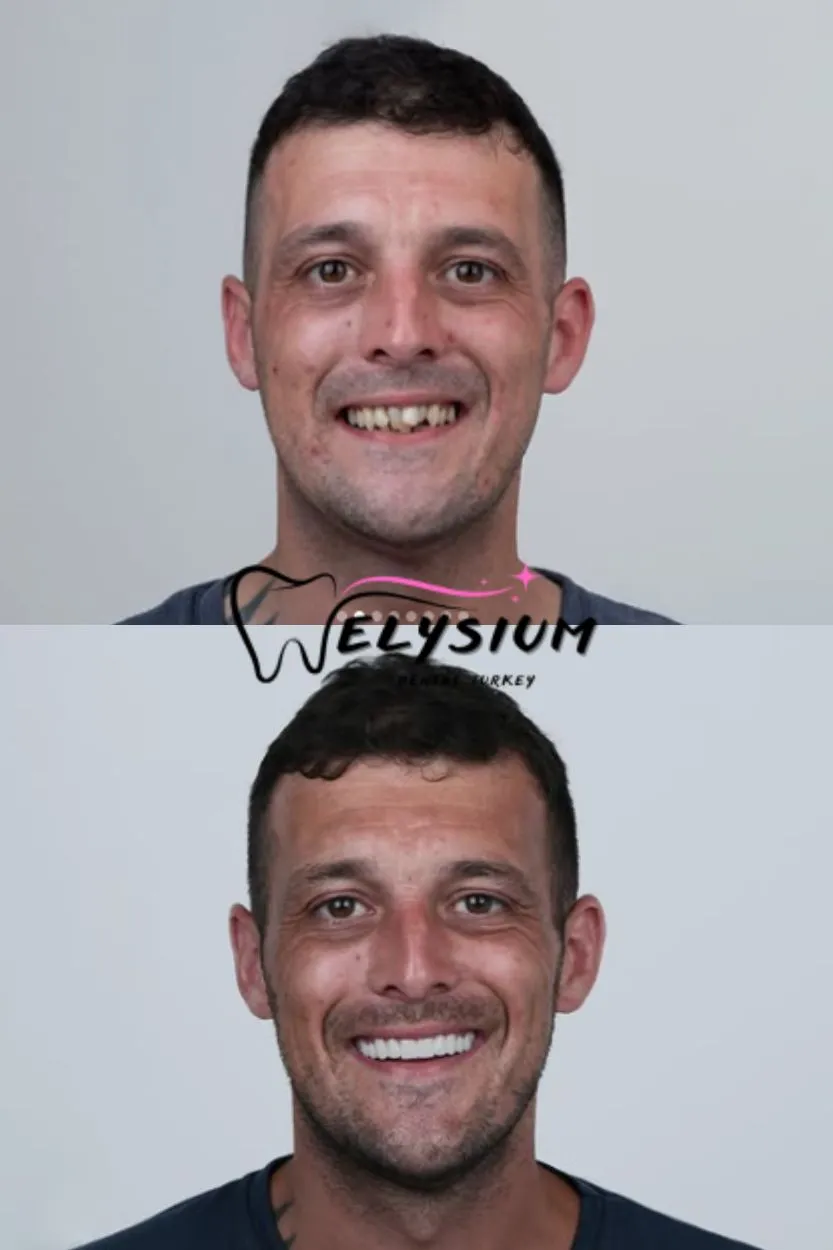 Antalya digital smile design