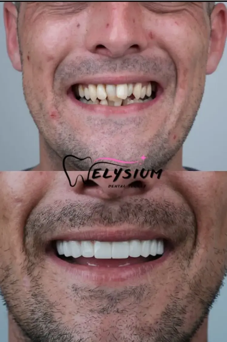 Antalya digital smile design