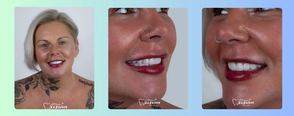 Turkey teeth price Antalya Turkey teeth price Antalya