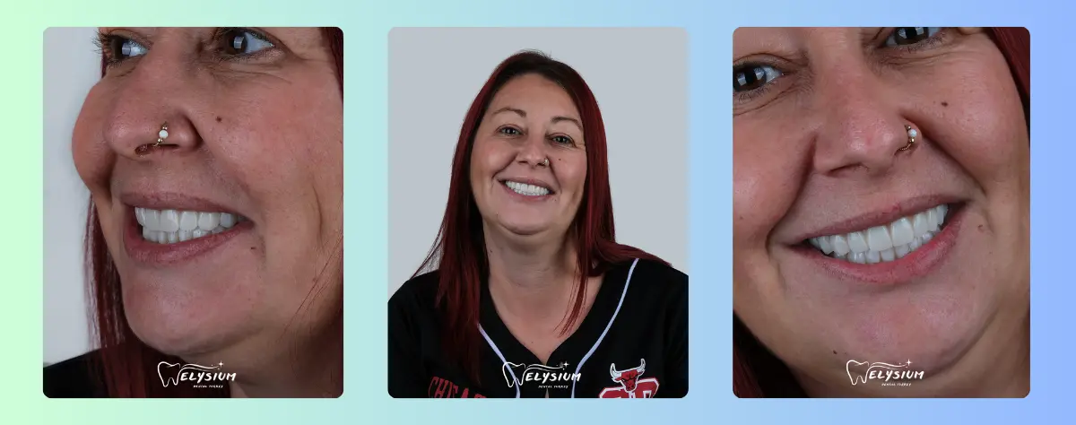 Dental implants cost Turkey Antalya Dental implants cost Turkey Antalya