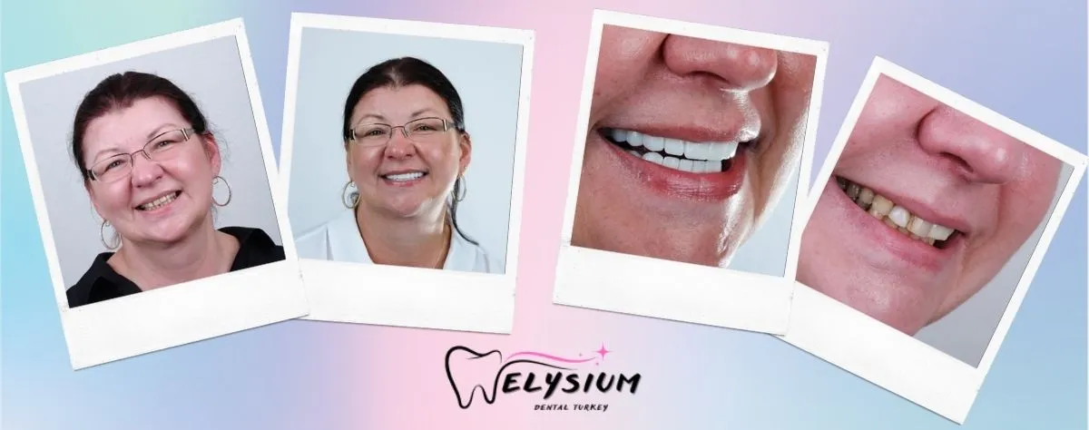 Zirconia crowns before and after Antalya Turkey Zirconia crowns before and after Antalya Turkey